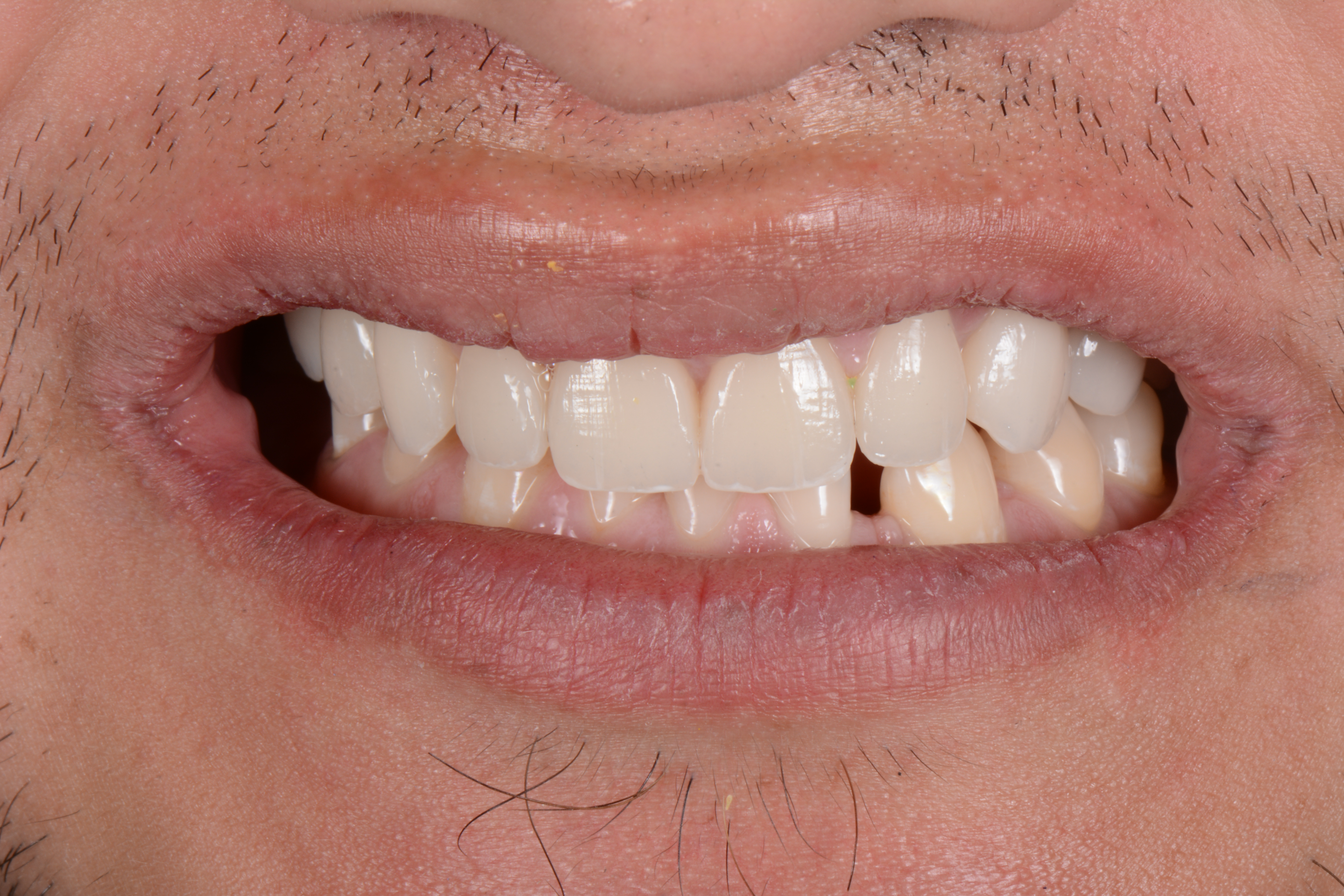 After treatment