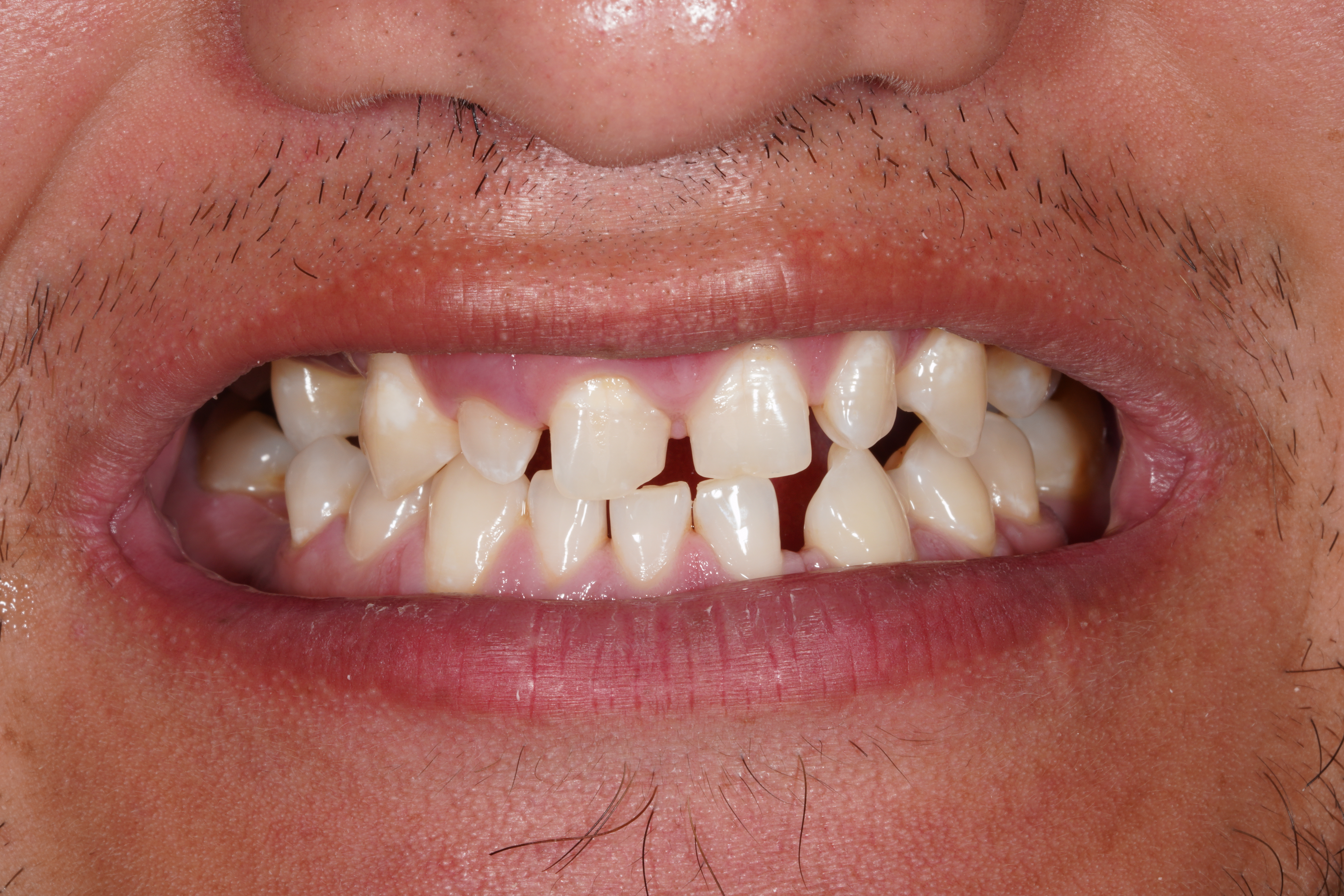 Before treatment