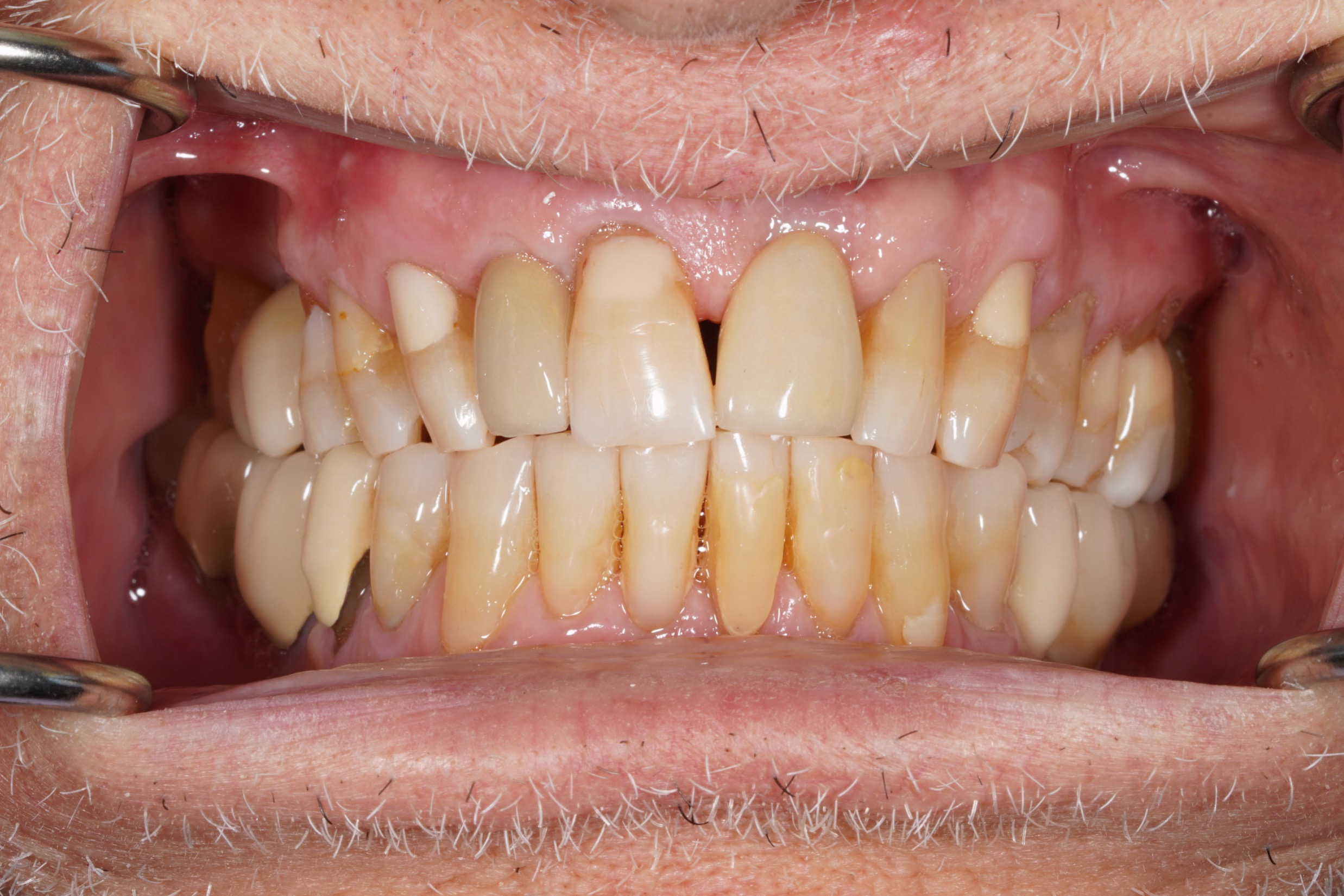 After treatment