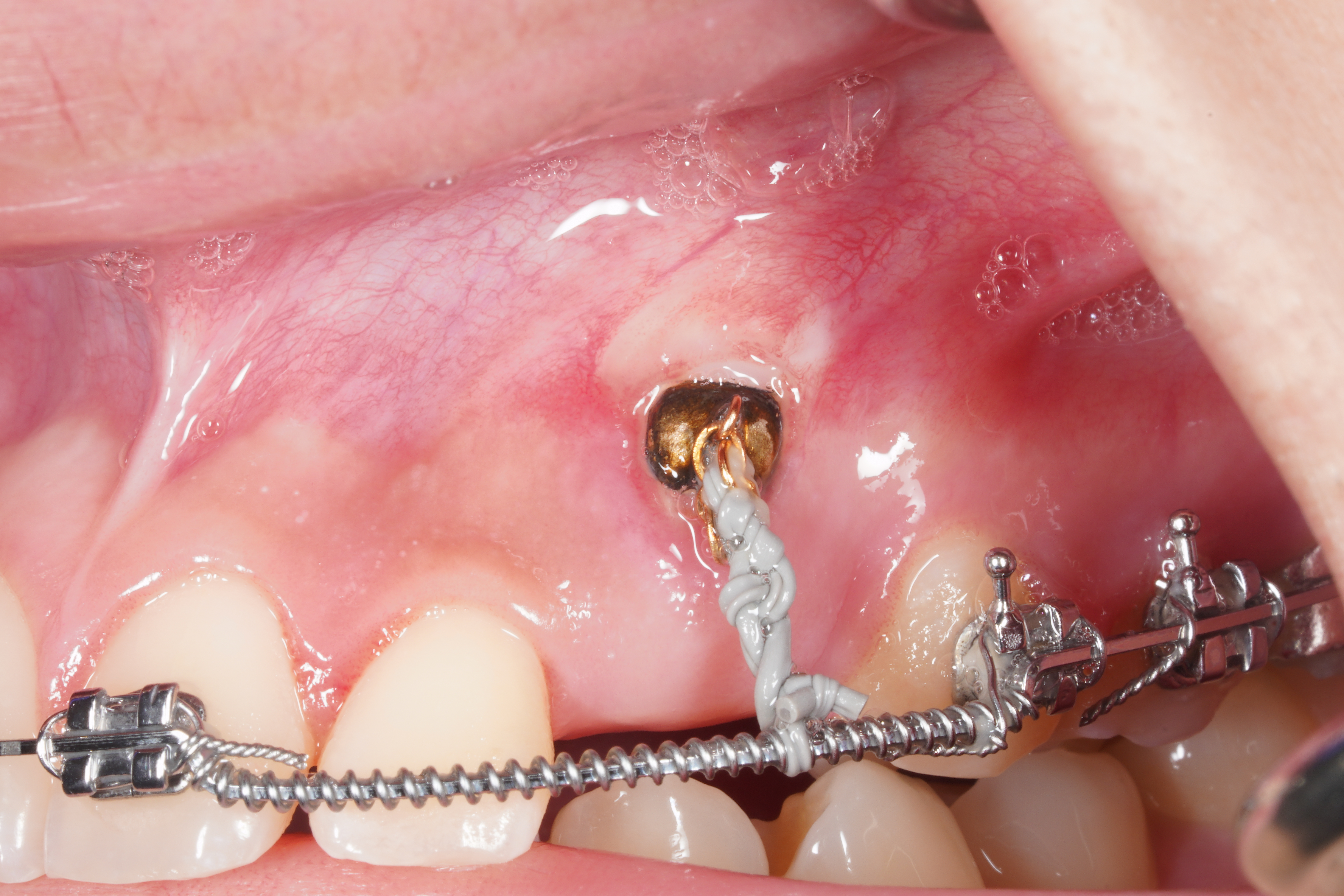 After treatment