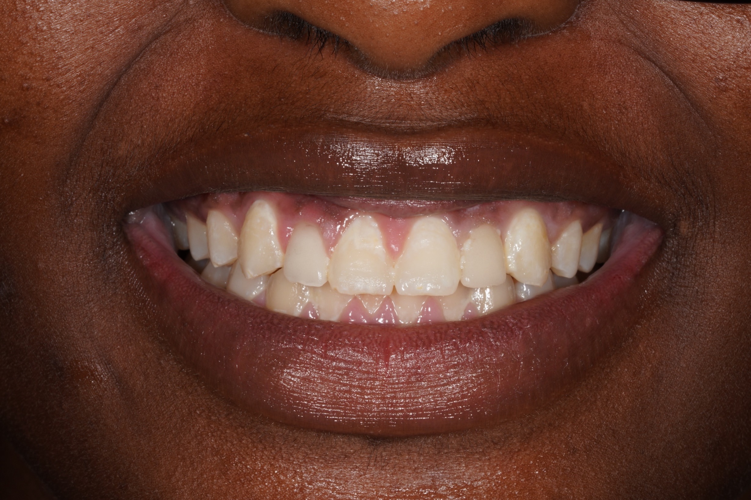 After treatment