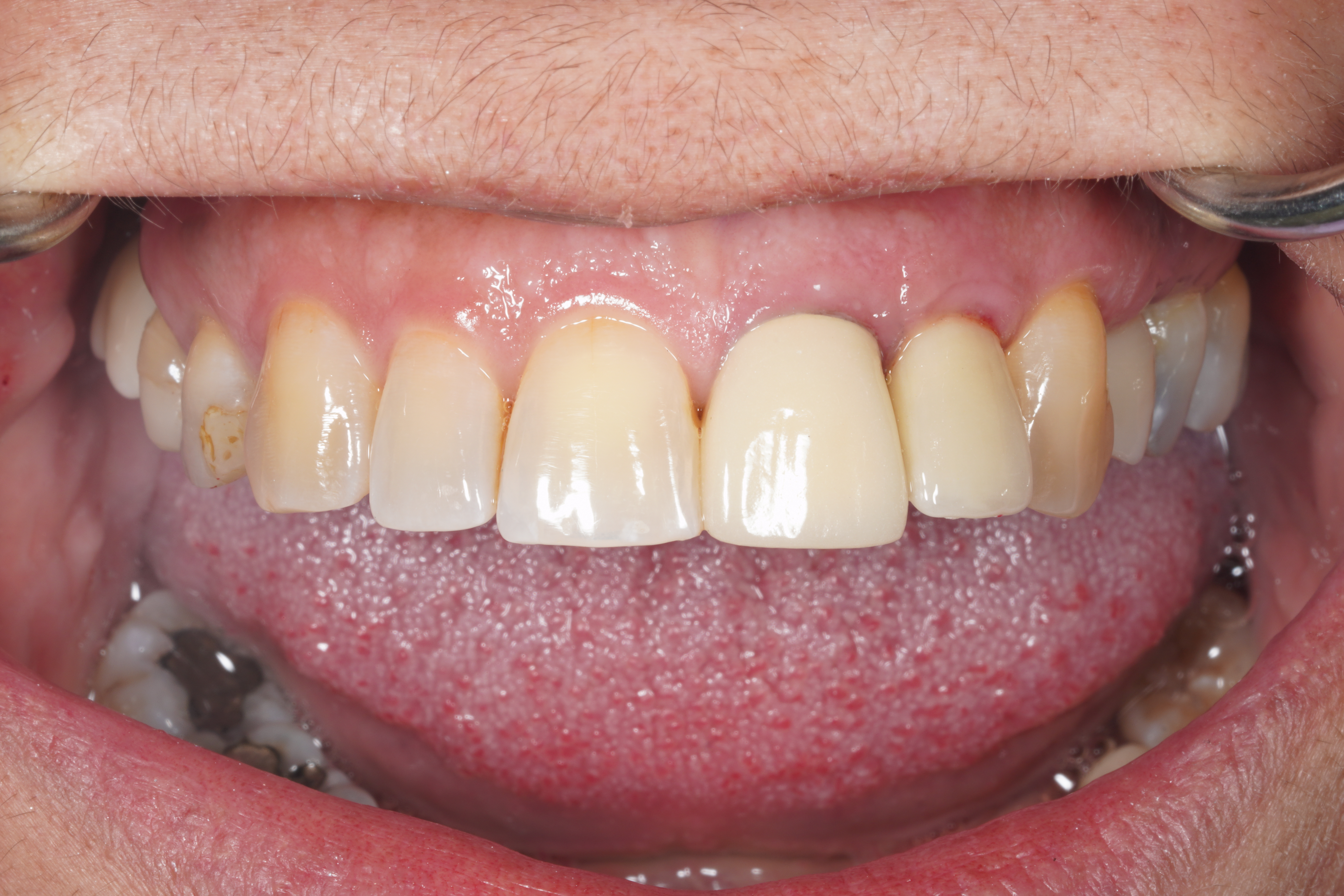 After treatment