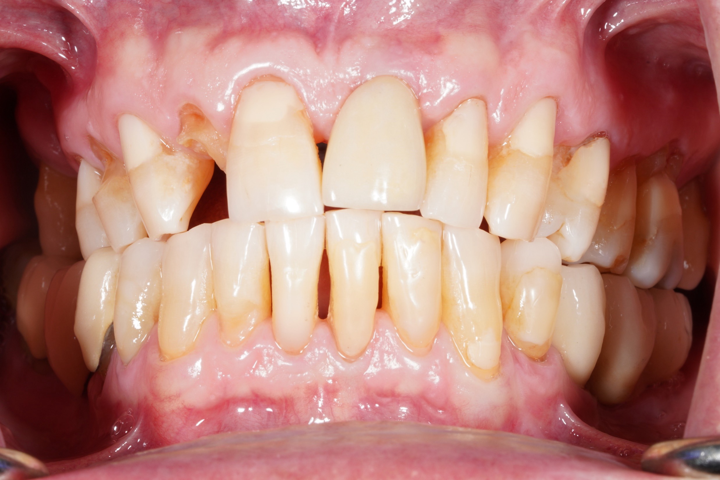 Before treatment