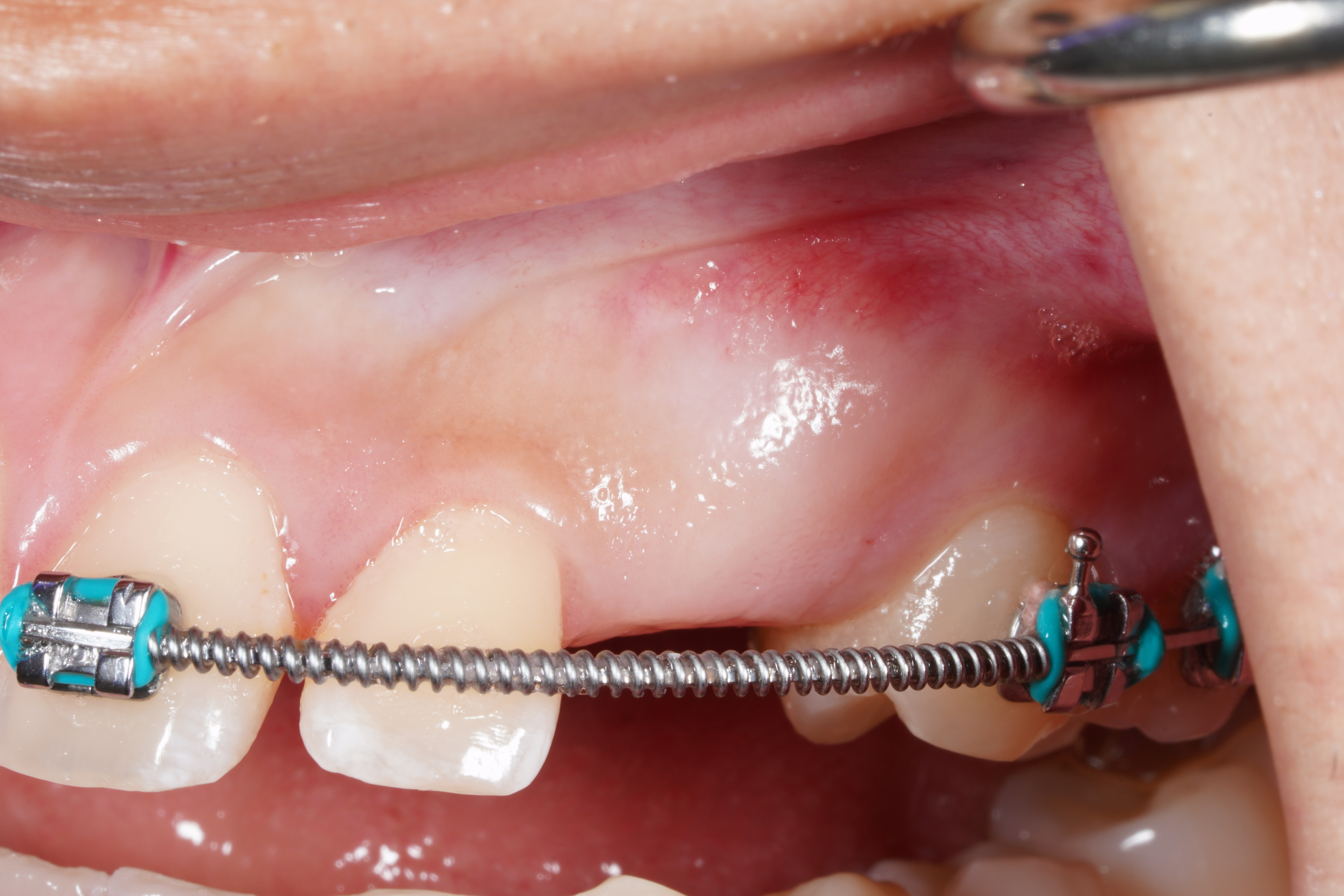 Before treatment
