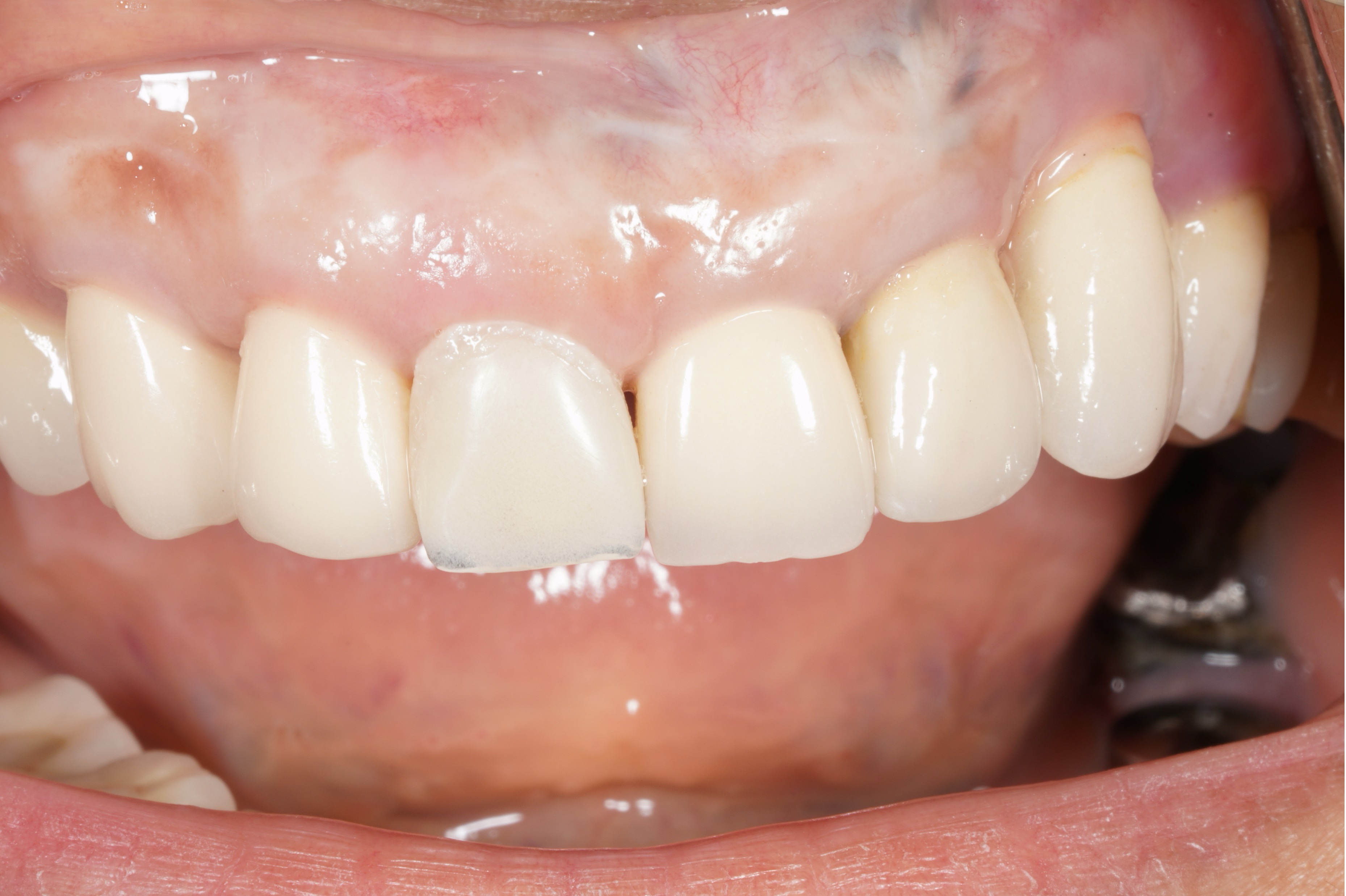 After Implant
