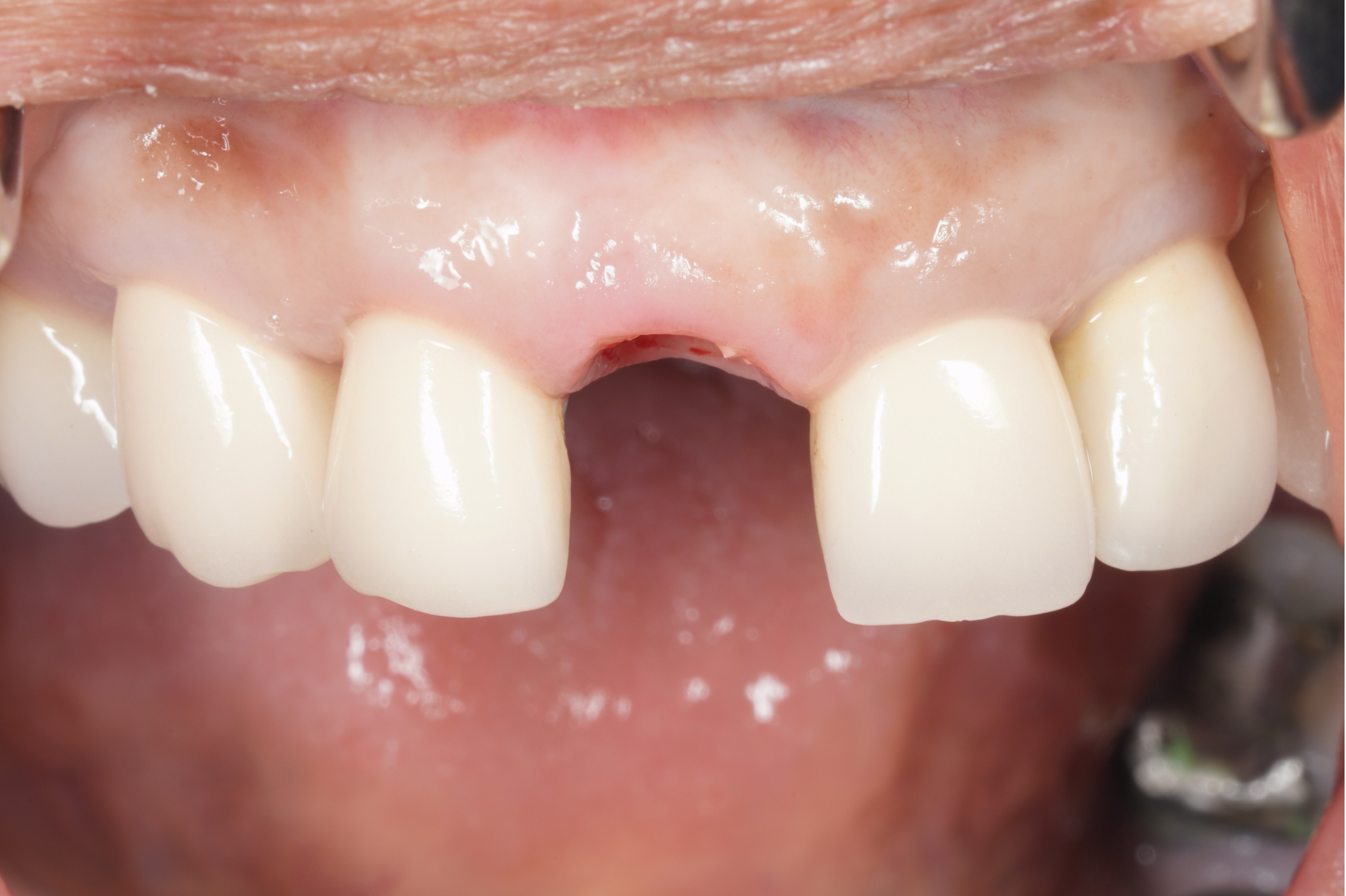 Before Implant