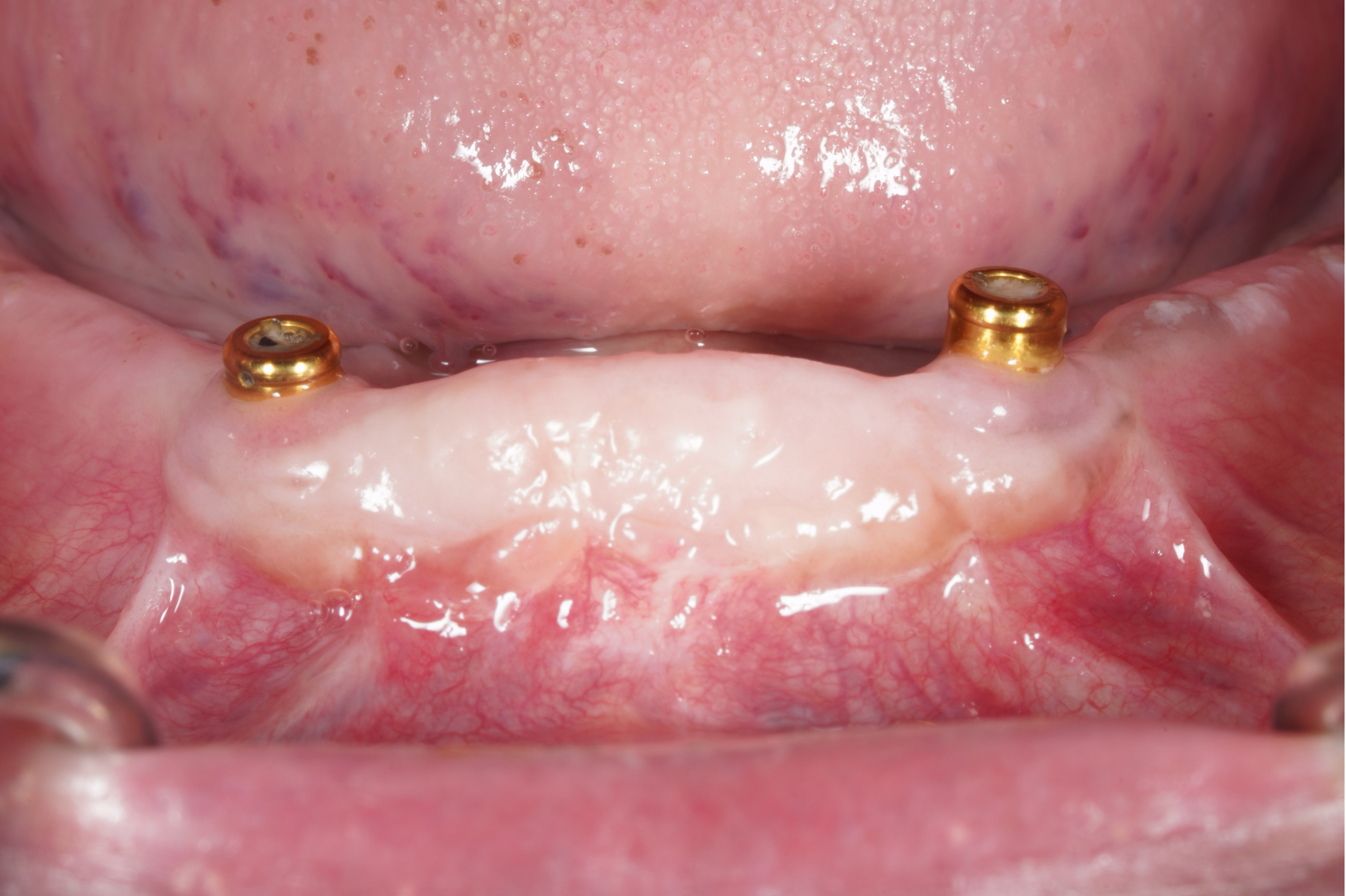 Bioclear Procedure