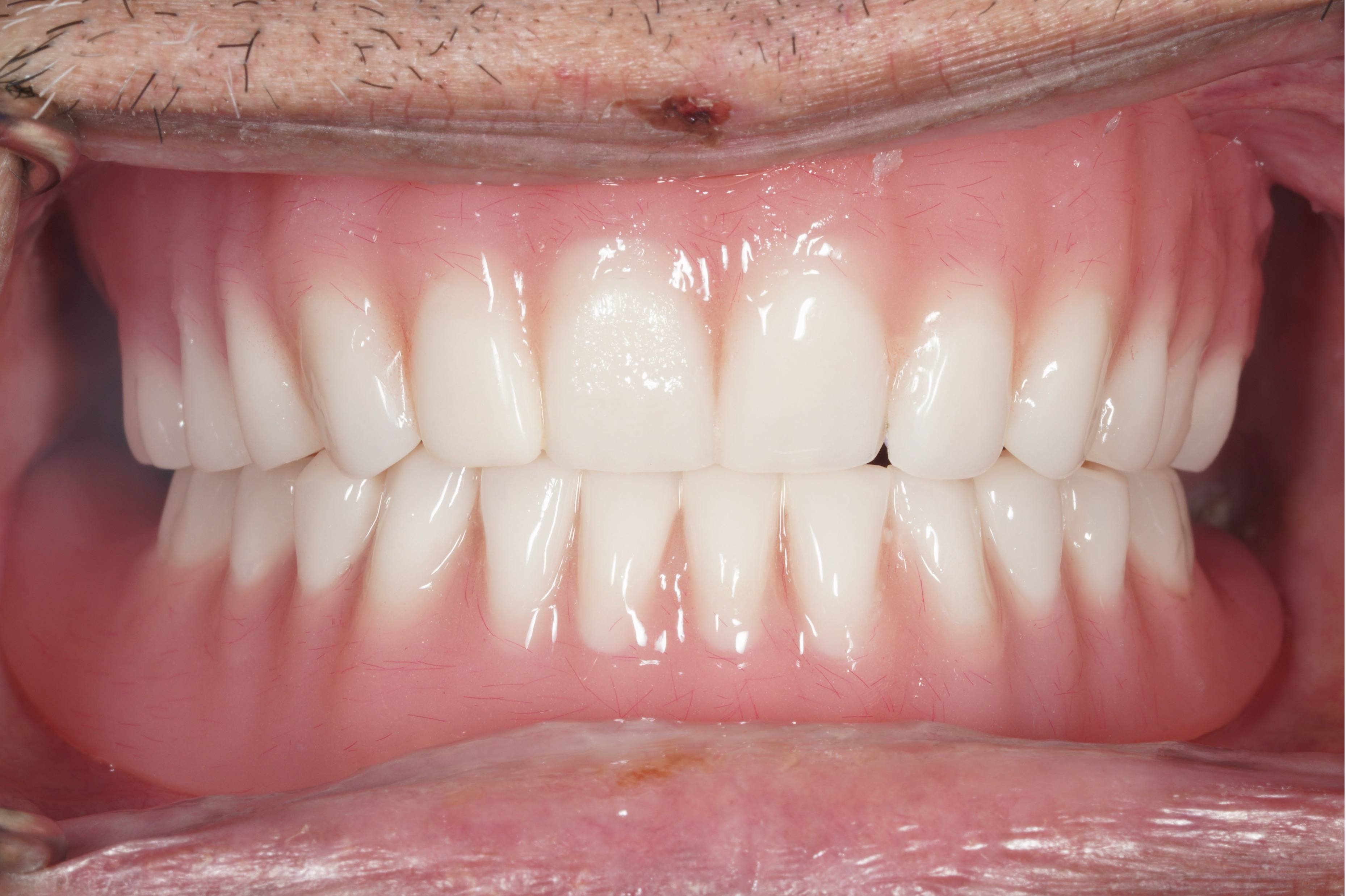 Bioclear Result Smile
